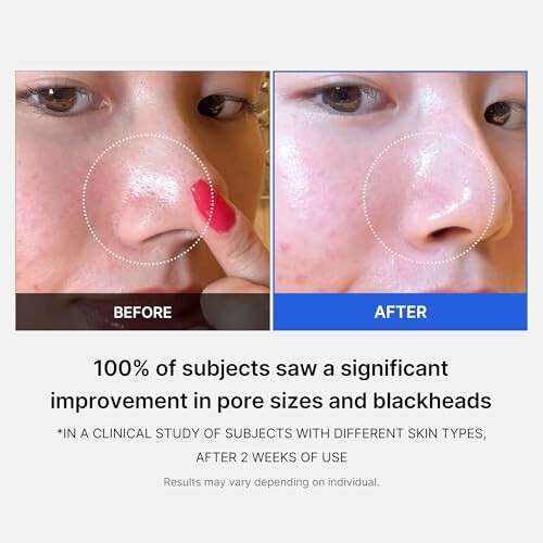 Before and after images showing pore size reduction on a nose.